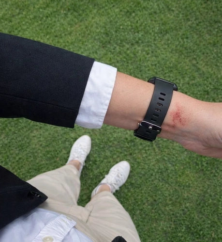 Skin irritation on wrist caused by a watch strap, highlighting the need for Fitbit Charge 6 bands suitable for sensitive skin
